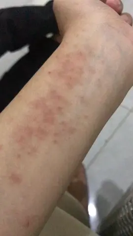 #VoiceEffects REVIEW JUJUR ‼️ Untuk menghilangkan rasa gatal pada ibu hamil dan memudarkan bekas lukanya #sediaBEEMEdirumahmu #skincareibudananak #beemeexperience #beemejuli #pregnant #bumil