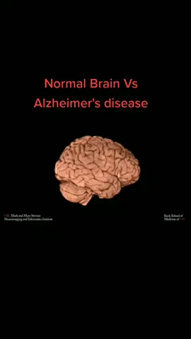 #healthy #brain Vs A Brain suffering from #alzheimer #disease  #science  #biology  #neuro  #wow  #age #life #human  #aging  #imaging  #think