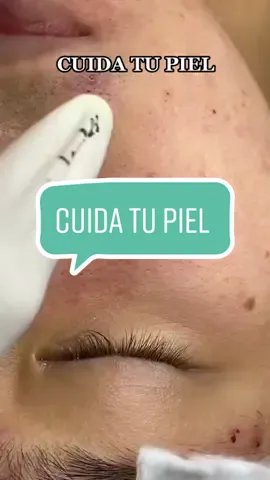 Cuida tu piel #hgw #hgwbolivia🇧🇴 #hgwchile🇨🇱 #hgwperu🇵🇪 #asmr #acnescars #прыщи #relax #espinillas #hair #spa #acne #pomping #granos #supppresss
