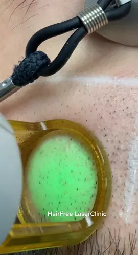 #laser #skincare #skin #fyp #voorjou #hairremoval #foryoupage #foryou #nohair #beauty #fypシ #Love #salon #satisfying #asmr #fy #men #beard #fy #laser