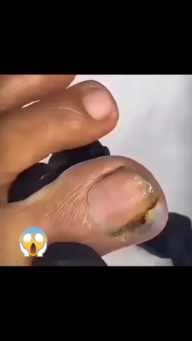 👣 #ingrowntoenail #ingrownnail #ingrown #ingrowntoenailremoval #ingrowntoenailsurgery #satisfying #viralvideo
