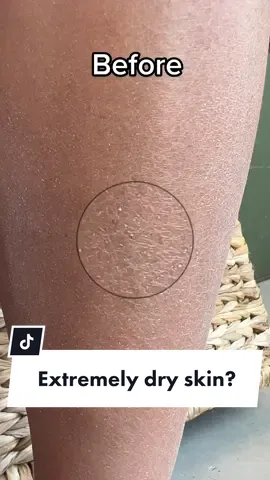 How to take care of those desert dry legs 🌵#dryskin #sheabutter #sheanilotica #drylegs