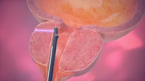 prostate #open #procedure #
