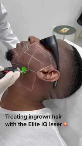Laser hair removal with the Elite iQ Nd:Yag laser. Safe & effective for dark skintypes!👏🏿👏🏾👏🏽 #laserhairremoval #laser #darkskin #melanin #skin #hairremoval @cynosurelasers #fyp #clinic