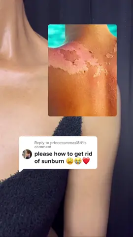 Replying to @princessmmasi841 SPF IS A MUST !!!🥺🙏🏽 #sunburn#skincare#spf