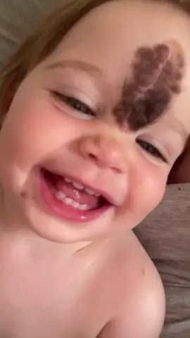 26DAYS‼️ 2nd surgery vienna borthmark removal. SAVE THE DATE 🤍 #fyp #foryoupage #viral #fypシ゚viral #raisingawareness #cmn #surgery #birthmark #birthmarkbaby #share @jenniferowens_