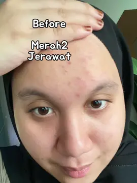 Tak semua org dpt merasa kulit flawless 🥹 #breakout #biocplus #salmonomega #fyp