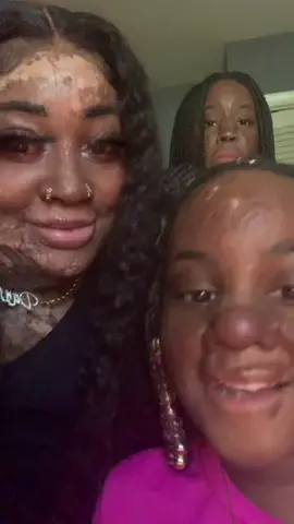 Happy Anniversary to us.Today is to celebrate 3yrs since the gas explosion.We are celebrating life today,we’re so blessed and thankful to be here with you all.God has been so good to us #fyp #burnsurvivors #girlswithscars #celebration #god #survivor #foryoupage