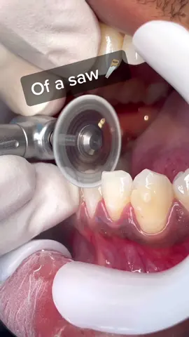 This is common in orthodontics! It’s called “IPR” which stands for interproximal reduction. Looks painful but it’s not! This process removes enamel & creates more space between teeth for better alignment. It helps fix crowded teeth! #dentist #teeth #tooth