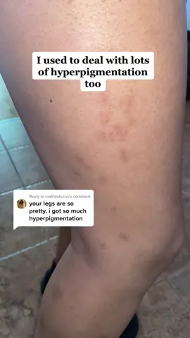Replying to @matildakurus YOU CAN GET RID OF IT ❤️❤️ #darkspots#skincare#hyperpigmentation