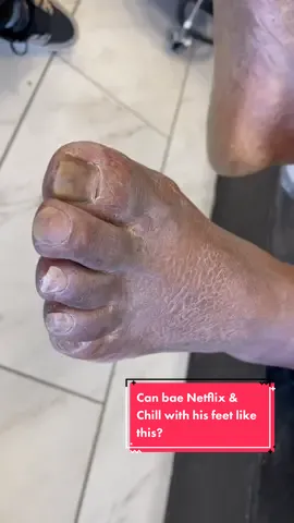 Xerosis or dryness of the skin of your foot can occur when the outer layer of the skin is deprived of moisture. #dryfeetoftiktok #pedicuresoftiktok