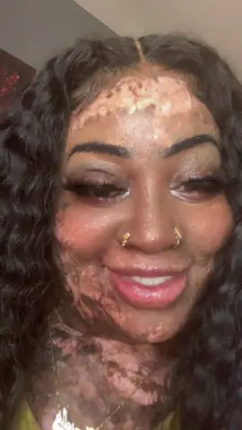 #fyp #burnsurvivor #girlswithscars #vibin #foryoupage