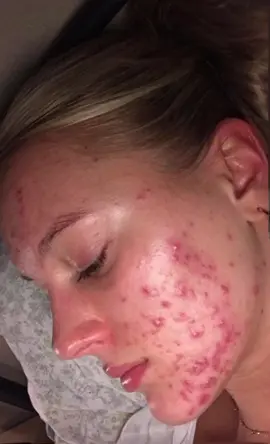 my skin transformation!! #acne #acnejourney #accutanebeforeandafter #skinbeforeandafter #accutane #guthealth #transformation #fyp