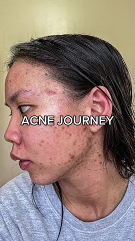 FROM NOVEMBER 2021 TO JULY 2022 #fyp #acnejourney #acnescars