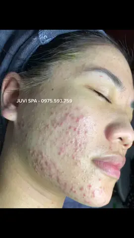 𝐋𝐀̀𝐌 𝐎̛𝐍 Đ𝐔̛̀𝐍𝐆 Đ𝐄̂̉ 𝐌𝐔̣𝐍 𝐍𝐀̣̆𝐍𝐆 𝐌𝐎̛́𝐈 𝐁𝐀̆́𝐓 Đ𝐀̂̀𝐔 Đ𝐈 𝐂𝐇𝐔̛̃𝐀  Cuối ngày Juvi tiếp nhận ca mụn siêu nặng , nặn rã tay gần 2 tiếng đồng hồ chưa xong 🥲 Lúc đầu khi mụn nhẹ em có ib hỏi qua chữa, nhưng không qua, tự mua sản phẩm về dùng, và sau 2 tháng mụn kín mặt luôn,  thương dã man :((( Đúng là tiền mất nhưng mụn không mất. Nên lời khuyên đối với các bạn, đừng để mụn quá nặng mới bắt đầu đi chữa nhé, vừa tốn nhiều tiền, mà phải chịu đau đớn, xấu xí nhé ✔️ Kết quả sẽ được Juvi up khi hoàn thành xong gói điều trị nhé  #DA_Mụn_Thâm_Nám_ #trimunchuankhoa #JUVISPA #trimunso1 #xuhuong2022