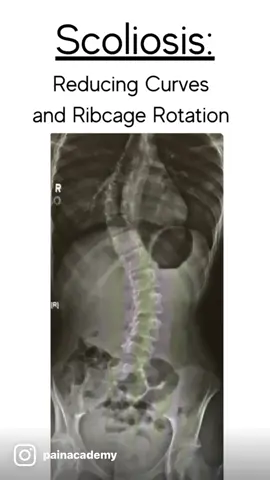 Just did a write up on this. Check out my other social account for context. #scoliosis #scoliosischeck #scoliosisawareness #fyp