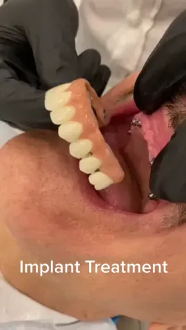 Implant treatment #implant #veneers #turkeyteeth🇹🇷 #fyp #explore #trending