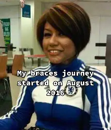 My braces journey. 2016 - 2020 #braces #bracesjourney #tiktokmalaysia #tiktok #tiktokmalaysia #tiktokviral