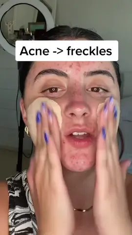 Replying to @krux_cosplay my secret to turning my strawberry freckles into freckles 🥰 #grwmmakeup #makeuptutorial #acnemakeup #acncecoverage #acneskin #acnepositivity #acneconfidence #realskin #skinpositivity #texturedskin