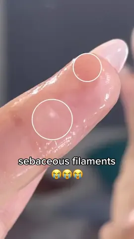 how I remove sebaceous filaments ‼️ #skincare #skincareph #fyp #4u #sebaceousfilament #blackhead