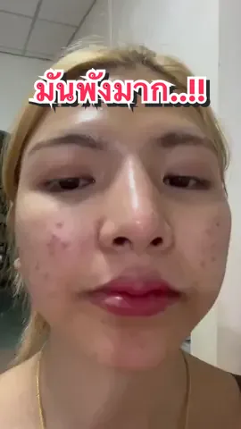 มันพังมากเว้ยแก🥲 #เอิร์นไดเม่ #สบู่ใบล่า #สบู่ลดสิว #ลดสิว #หน้าใส @eoirn_eoirn 