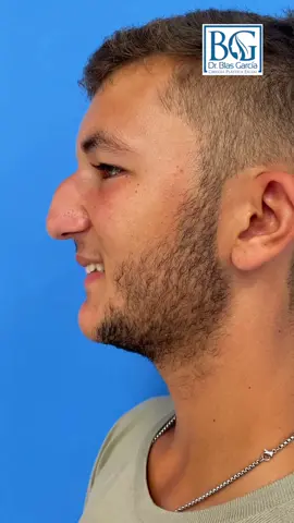 Rinoplastia ultrasonica #drblasgarcia #rinoplastiaultrasonica #rinoplastia #rhinoplasty #nosejob #fyp #fypシ #parati #foryou #foryoupage #tiktok #viral #xyzbca #anime #trending