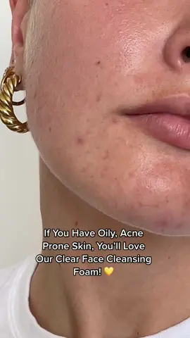 Like washing your face with clouds! ☁️ ✨ #cleansingfoam #foamcleanser #acneskincareproducts #acneproneskin