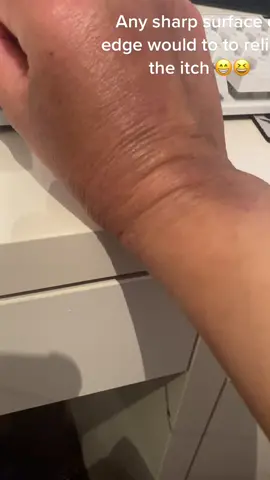 #eczema #hands #itchy #relievetheitch #scratch #eczemaawareness #shortnails #tiktok #fyp #foryoupage #ultragreens #allergies #pigmentation