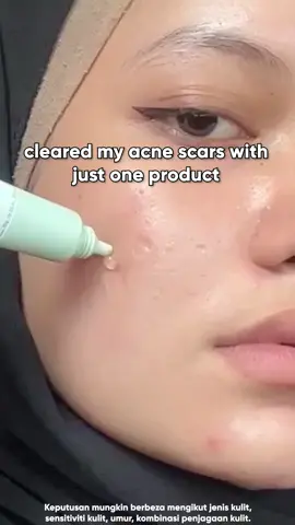 A quick solution to overcome #acne by using Salicylic Acid Spot Treatment products from SKINTIFIC 😍#skintificmy #ramadantiktokshopping