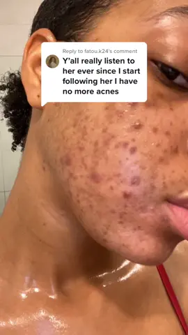 Replying to @fatou.k24 FILLS MY HEART WITH JOY !!!! ❤️❤️❤️ #acne#clearskin#skincare