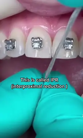 Shaving down teeth for Braces 😅🦷😁