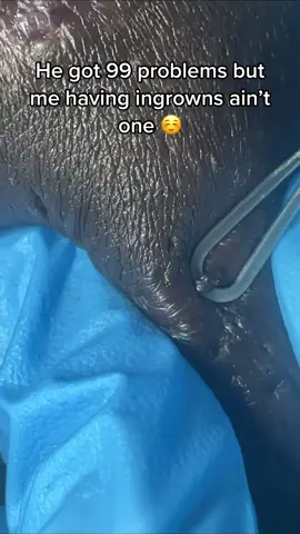 #extractions #galaxyextraction #ingrownhairremoval #99problems