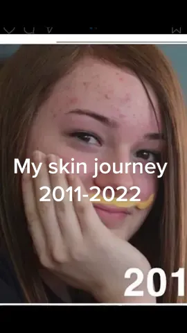 My skin journey from 2011-2022. Ive had acne, sensitized and angry skin. A lot of congestion. I was so insecure and felt awful about myself. I’ved worked hard at my skin for 11years. Becoming an aesthetician and acne specialist was the best thing i ever did for myself❤️ Im now confident in myself and so happy that im able to help others in their skin journey. Its a tough road but its so worth the journey. #skin #acne #aesthetician #phoenix #arizona #SelfCare #gilbert