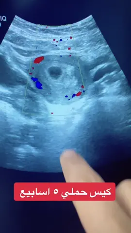 كيس حمل ٥ اسابيع #طبيبة#طبيبة_نسائية #طبيب_تيك_توك #سونار #المانيا #اسطنبول #اوروبا #تاخر_حمل #حوامل#حوامل#حوامل_كيوت #تيك_توك #تركيا#اكسبلور
