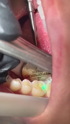 Our office provides Solea Laser. A new dental laser technology that is virtually replacing the needle in the dental office’s. It’s used for all ages! 😁 #fyp #laser #dentist #dentalfillings 