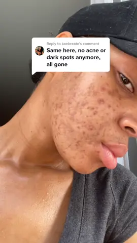 Replying to @kaekreate WE ARE GETTING RESULTS TOGETHER!😍 Click the link in my bio to join me! #acne#skincare#clearskin