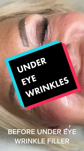 Under eye weinkles targeted with superficial filler #filler #wrinkles #antiaging #happyclient #kirax