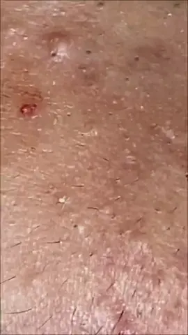 Check link in bio for new extraction tools #popping#removal#extractions#fry#fryp#parati#paravoce#viral#gipleariswing#black#heads#blackhead#pimple#tiktokmademebuyit 