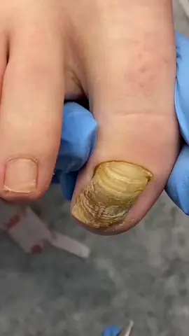 #fungus #mycosis #onychomycosis #fungaltoenail #fungaltoenailtreatment #toenailtreatment #footpain #fyp #satisfying #relaxing #viralvideo @FootWorks Relaxing 