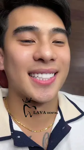 Có bao nhiêu cô gái thích nụ cười của chàng trai này, vừa hoàn thiện 16 răng sứ cho e zai sinh năm 96#răng_sứ_thẩm_mỹ 