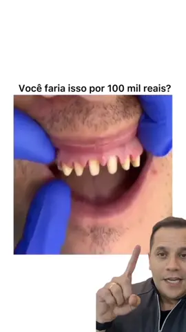 precisa desgastar muito os dentes pra fazer lentes de contato dental?#lentesdecontatodental