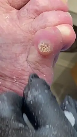 #footpain #fyp #viralvideo #satisfying #callusremoval #painful #podiatry #satisfyingvideo #myfootarekillingme #callus #trendingvideo #calluses #healthyfeetpodiatry #pedicure #crackedfeet @FootWorks Relaxing 
