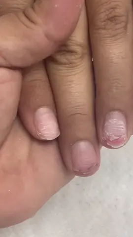 This Is How Nails Get Damaged From Wrong Removals 💗💗 hope my voice isn’t horrible lol #nailremoval #damagednails #howtoremoveacrylicnails #torontonailtech