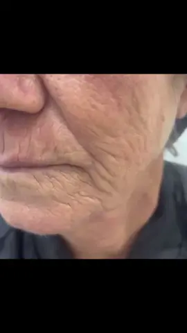 Rugas periorais ou código de barras, elas são difíceis de tratar, mas saiba que existe solução! Esse foi apena um peeling com 10 dias de antes e depois #cuiaba #varzeagrandemt #matogrosso #viral #ticktock #rotinaskincare 