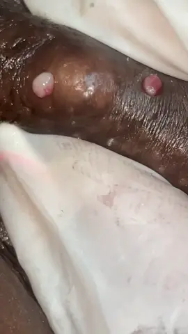 I just wanted to use this sound 😂 #wetextraction #galaxyextraction #ingrownhair #cystpopping 