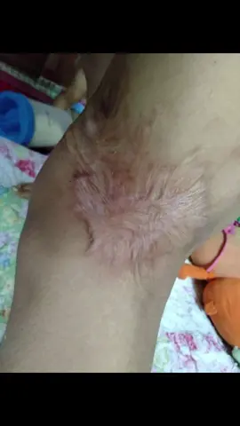 Before & after . Halos buong left leg ko nasunog nung taong 2000 . The power of 