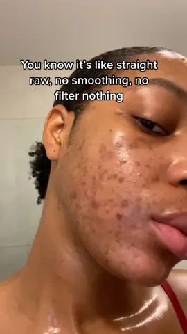 Love @amrezy the audio was hilarious 😂😂❤️ didn’t get my skin on Amazon though! It is a lot of hard work and dedication!!! You can’t cheat your way to clear skin, you have to earn your way to it!! 🔥 #darkspots#clearskin#acne