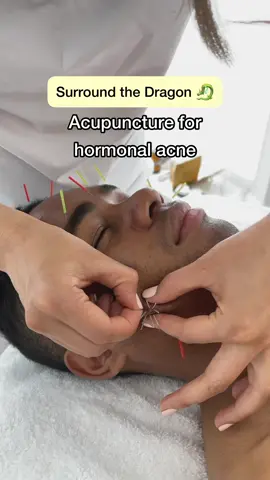 Visit an acupuncturist with us to treat hormonal acne using a traditional spot treatment method📍#tcm #chinesemedicine #acupuncture #surroundthedragon #hormonalacnetreatment #easternmedicine