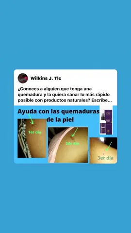 Tienes algunas quemaduras  ??? Yo te puedo ayudar a curarlas lo más rápido posible 🙌🏽🙀#quemaduras #quemargrasa #quemadurasdesol #productosnaturales 