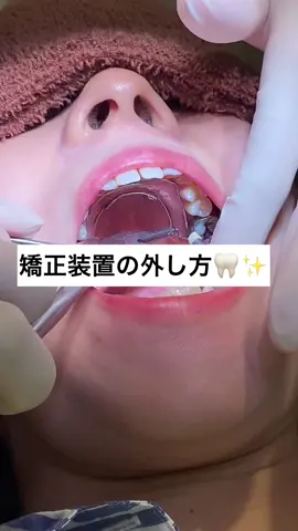 矯正装置の外し方🦷✨　#矯正歯科 #歯列矯正 #ワイヤー矯正 #矯正してる人と繋がりたい #リング#除去